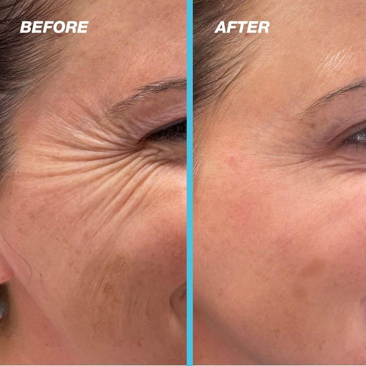 Kora™ – Silicone Scar Sheets